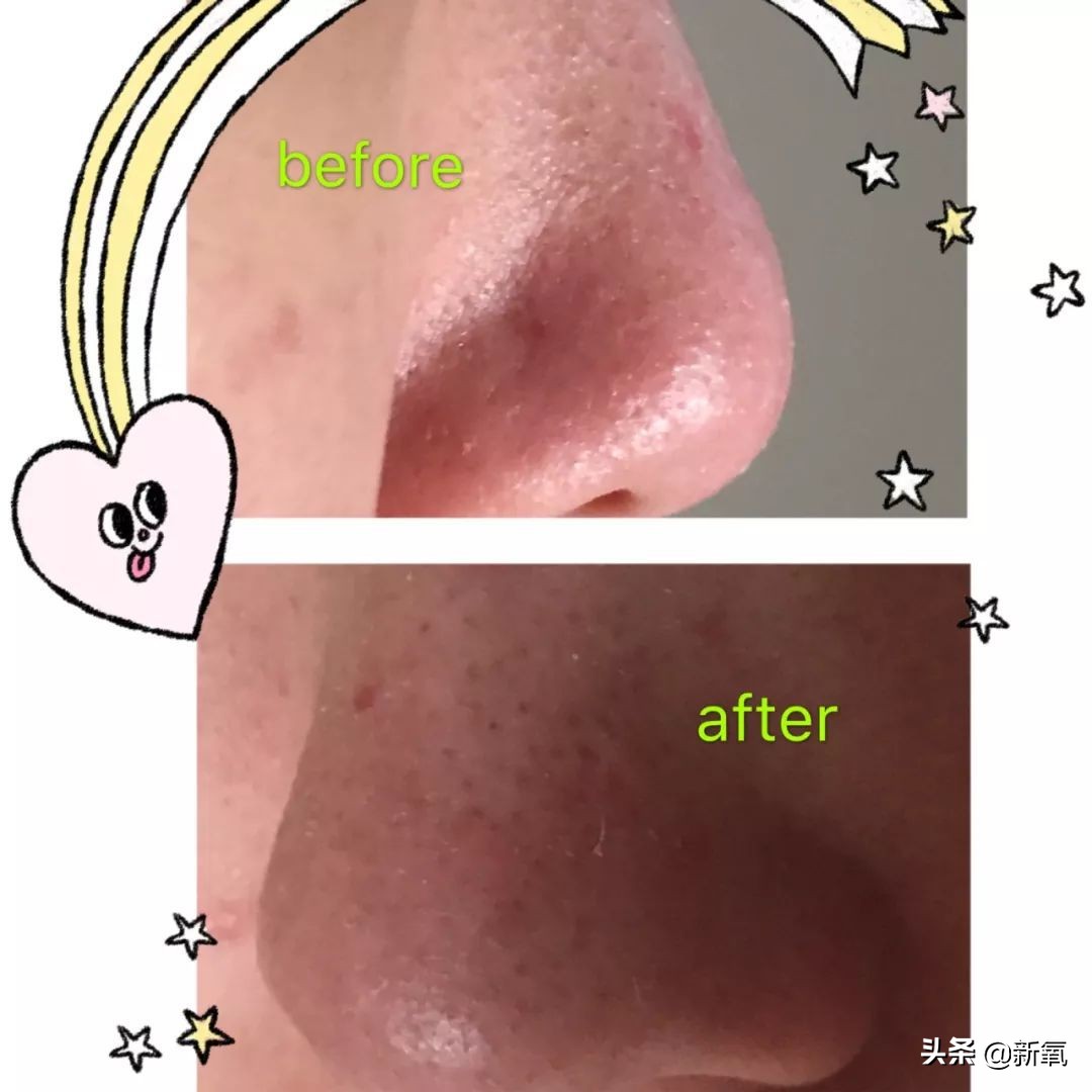 目前有真正去黑头的方法,最近超火的去黑头