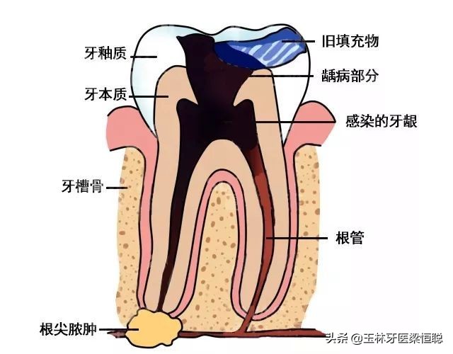 牙齿发炎的原因及解决方法,牙齿发炎特别严重要拔掉