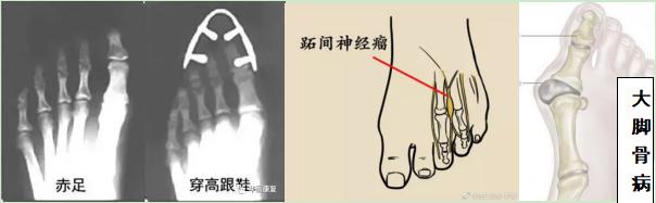 为了美，你愿意上麻药穿红色高跟鞋吗？