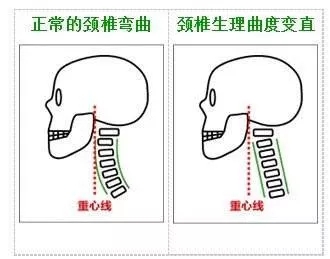 3d演示颈椎生理曲度变直牵引过程,颈椎生理曲度变直如何自行恢复