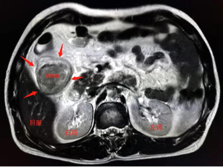 肚子咕噜咕噜响胀气是怎么回事,肚子咕噜胃胀气