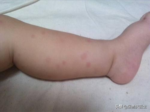 牛奶蛋白过敏吃什么奶粉好,牛奶蛋白过敏可以吃母乳吗