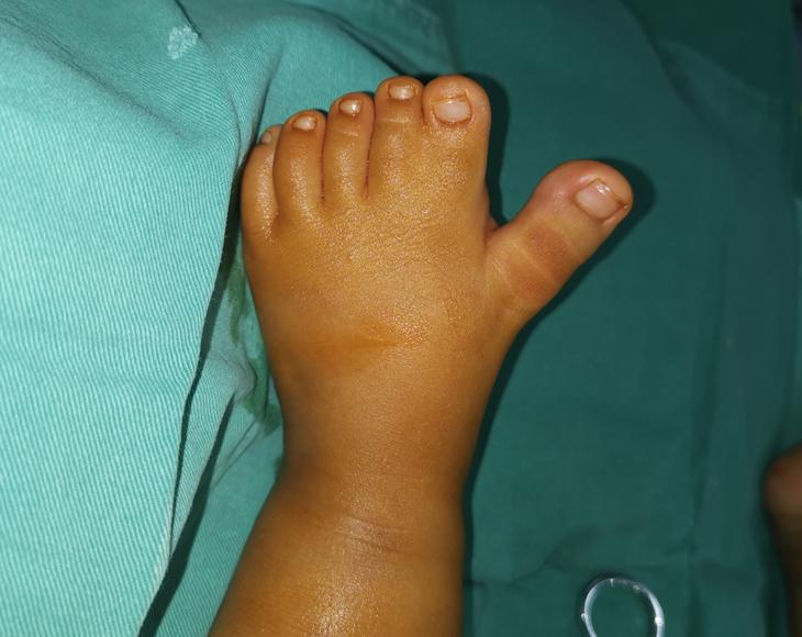 并指畸形免植皮案例,并指畸形