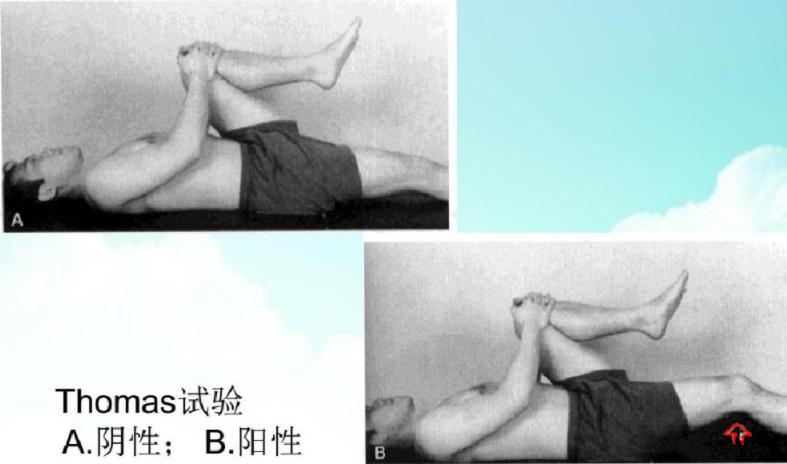 右侧骨盆前倾的最有效的矫正方法,下交叉综合症骨盆前倾矫正