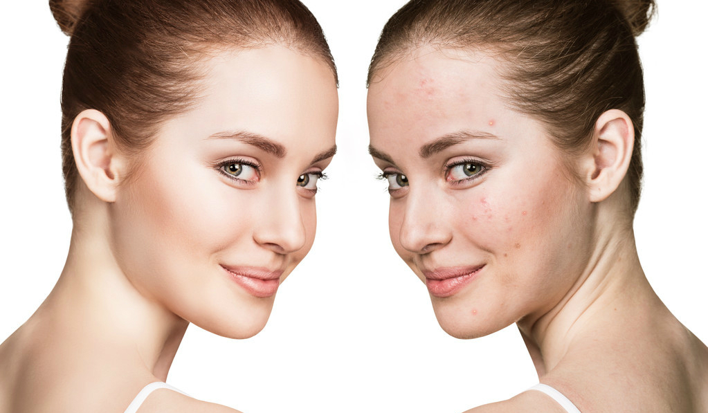 长痘位置对应五脏六腑,人脸长痘对应的五脏六腑图