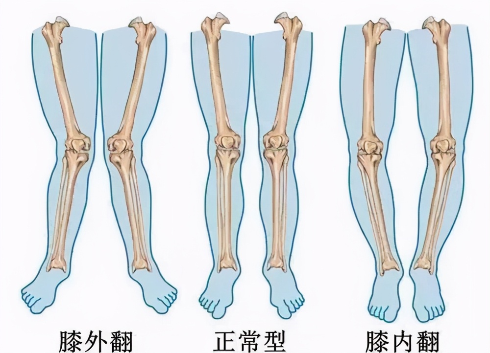 膝骨关节炎只能“换关节”?看看关节外科大夫如何“保膝”