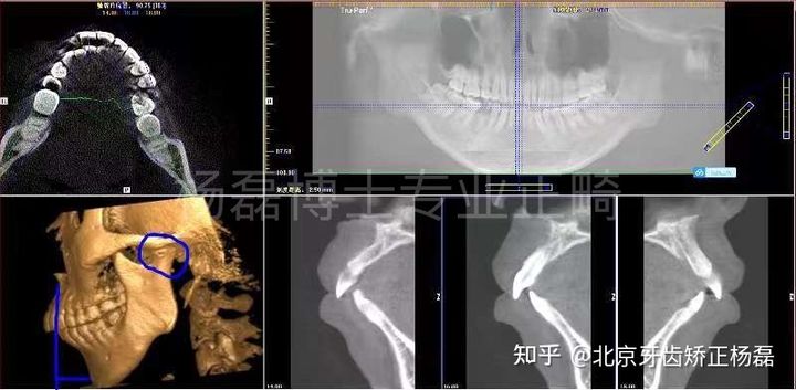 颞下颌关节紊乱精神紧张复发,颞下颌关节紊乱症能做牙齿矫正吗