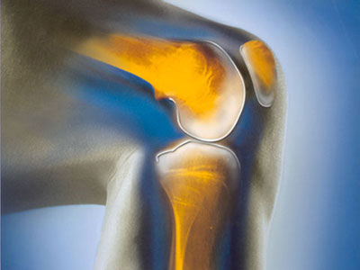 膝关节为何会退变?生活中少做哪些事,可预防膝骨关节炎?