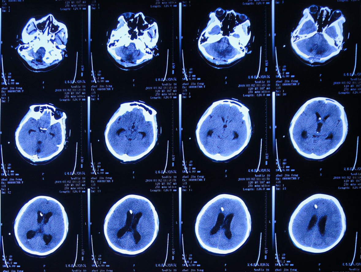 脑出血后脑积水会造成意识不清吗,脑出血后脑积水发高烧危险期多久