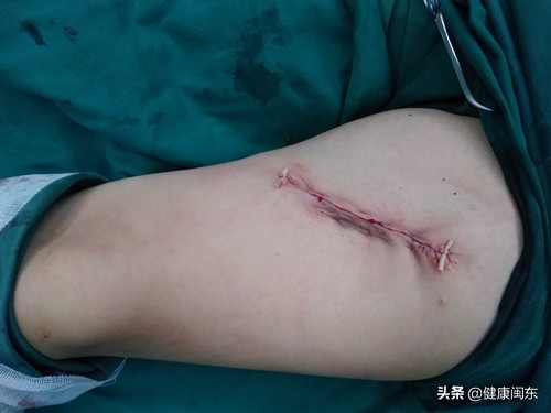 纹身需慎重身体伤害大祛除很苦恼