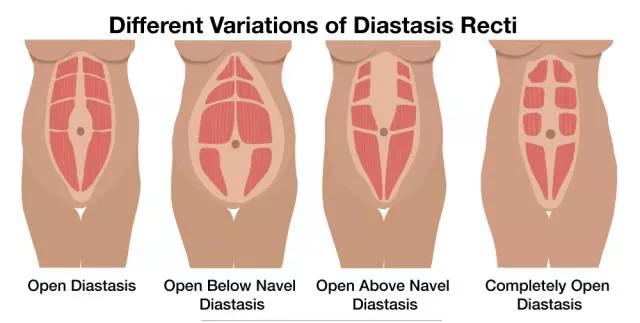 腹部训练腹直肌分离腰痛,腹直肌分离会引起腰痛吗