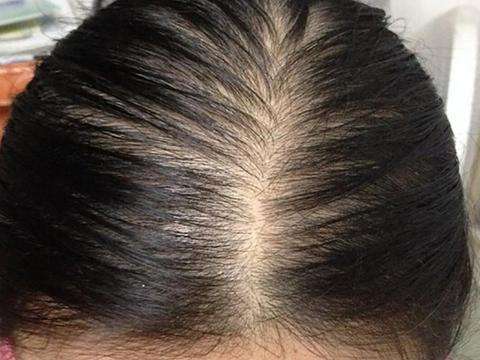 甲醛会不会引起秃顶,甲醛闻多了会头秃吗