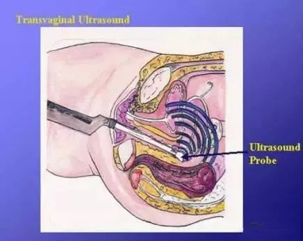 阴部超声检查什么时候做,妇科阴式超声检查方法