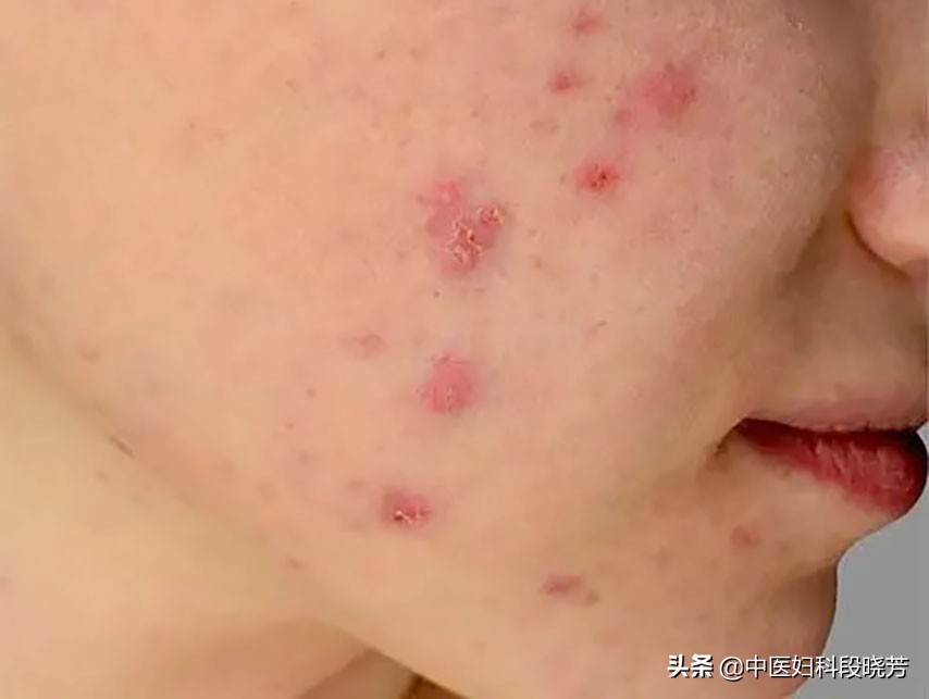 多囊要调理多久月经周期会正常,多囊月经频繁怎么治疗最有效