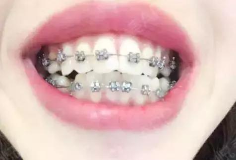 牙齿疼痛按摩哪里可以缓解,矫正牙齿打钢钉几天能缓解疼痛