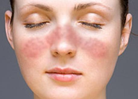 系统性红斑狼疮无法治愈,系统性红斑狼疮能多长时间治好