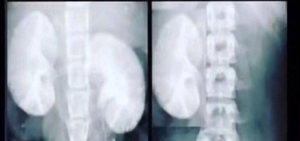 痛风引起高血压先降什么,痛风导致的高血压可以治愈吗