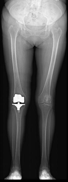 膝关节阶梯治疗ppt,膝关节骨性关节炎阶梯化治疗