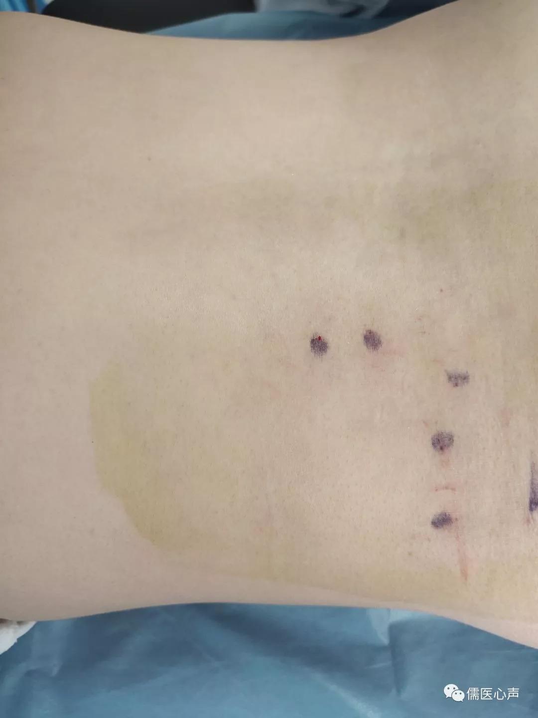 腰部往里凹了经常疼,腰部往上一点脊柱两侧疼痛的原因