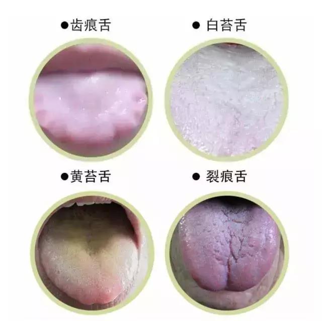 拉肚子和肝胆脾胰肾有关系吗,湿热拉肚子中医辨证