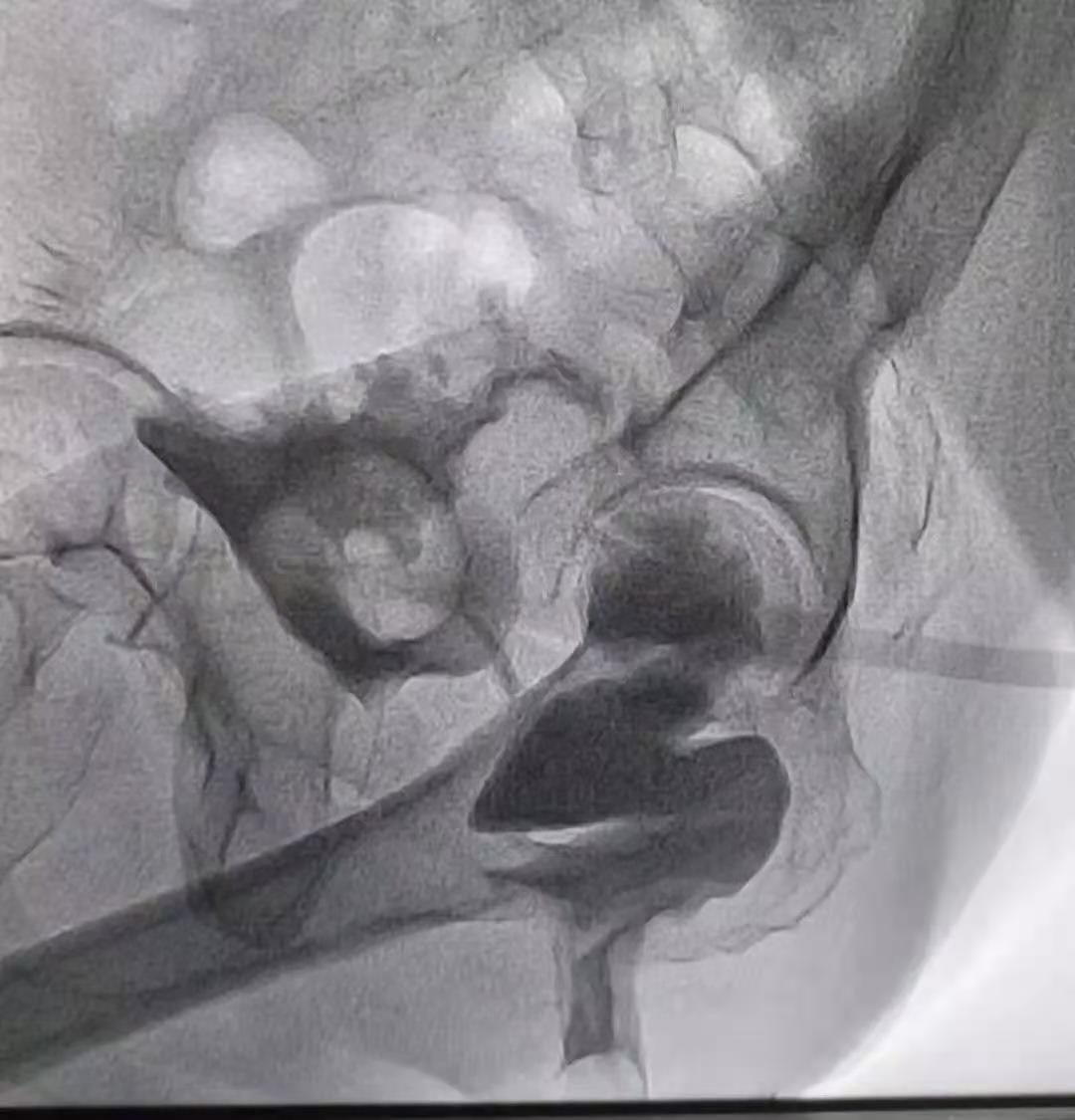 憩室炎怎么治疗效果最好,切口憩室有什么很好的治疗办法吗