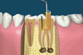牙齿做根管治疗放的是什么药,牙没坏但是疼需要做根管治疗