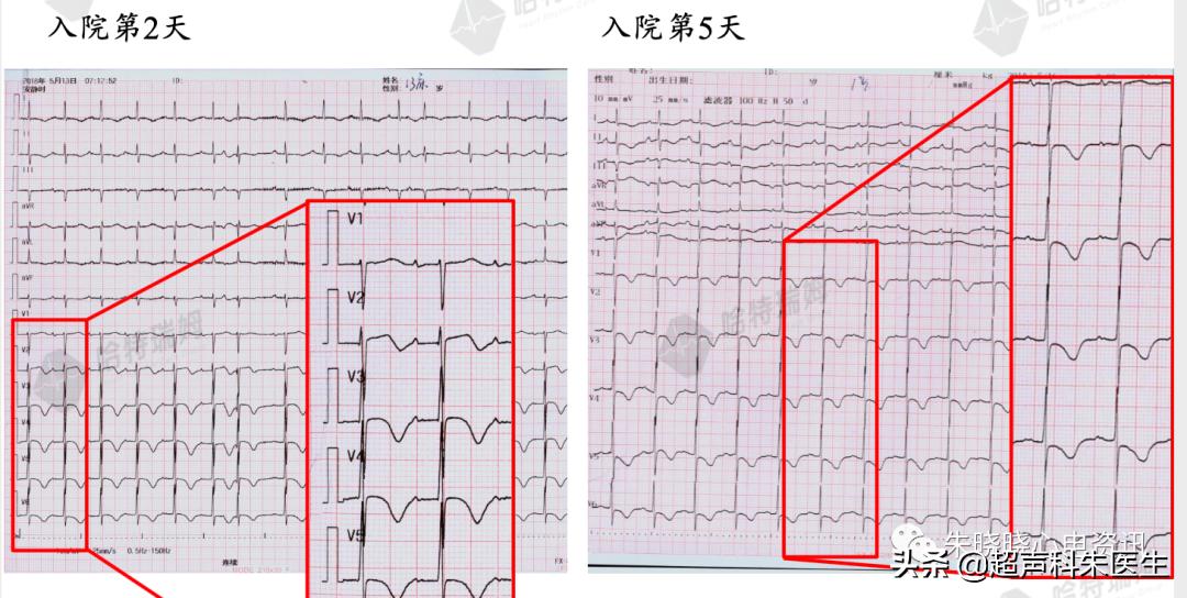 t波倒置诊断,t波倒置如何区分严重程度