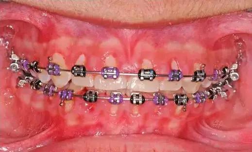 矫正牙齿是如何戴牙套的,矫正牙齿戴牙套需要注意事项