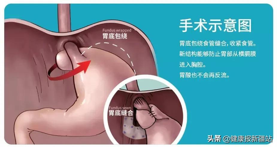 内镜下治疗胃食管反流手术怎么样,自治区人民医院做腹腔镜手术