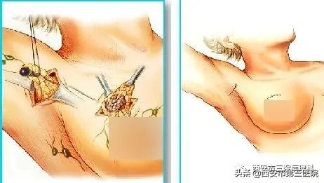 乳腺癌治疗史的不断演进,中医讲乳腺癌的真实故事