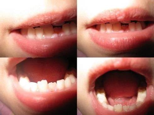 换牙后新牙锯齿状怎么回事,小孩换牙后长出来的牙是锯齿状的