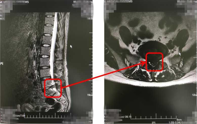 腰椎间盘突出便秘能用开塞露吗,腰椎间盘突出平时还便秘怎么办