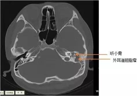 “耳屎”太多被同事吐槽!杭州漂亮姑娘去医院一查,吓得直掉眼泪