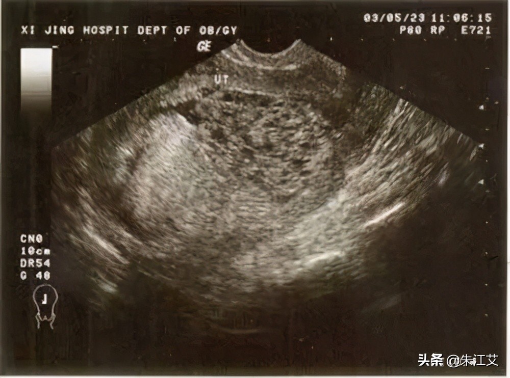 子宫异常出血和功能性出血的区别,育龄妇女子宫异常出血一直出血