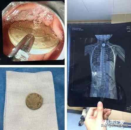 儿童吞了硬币到肠道了怎么取出,3岁小孩误吞硬币做什么检查