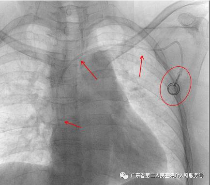 输液港能多次做吗,输液港可以重复使用吗