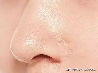 激光治疗草莓鼻,激光换肤草莓鼻