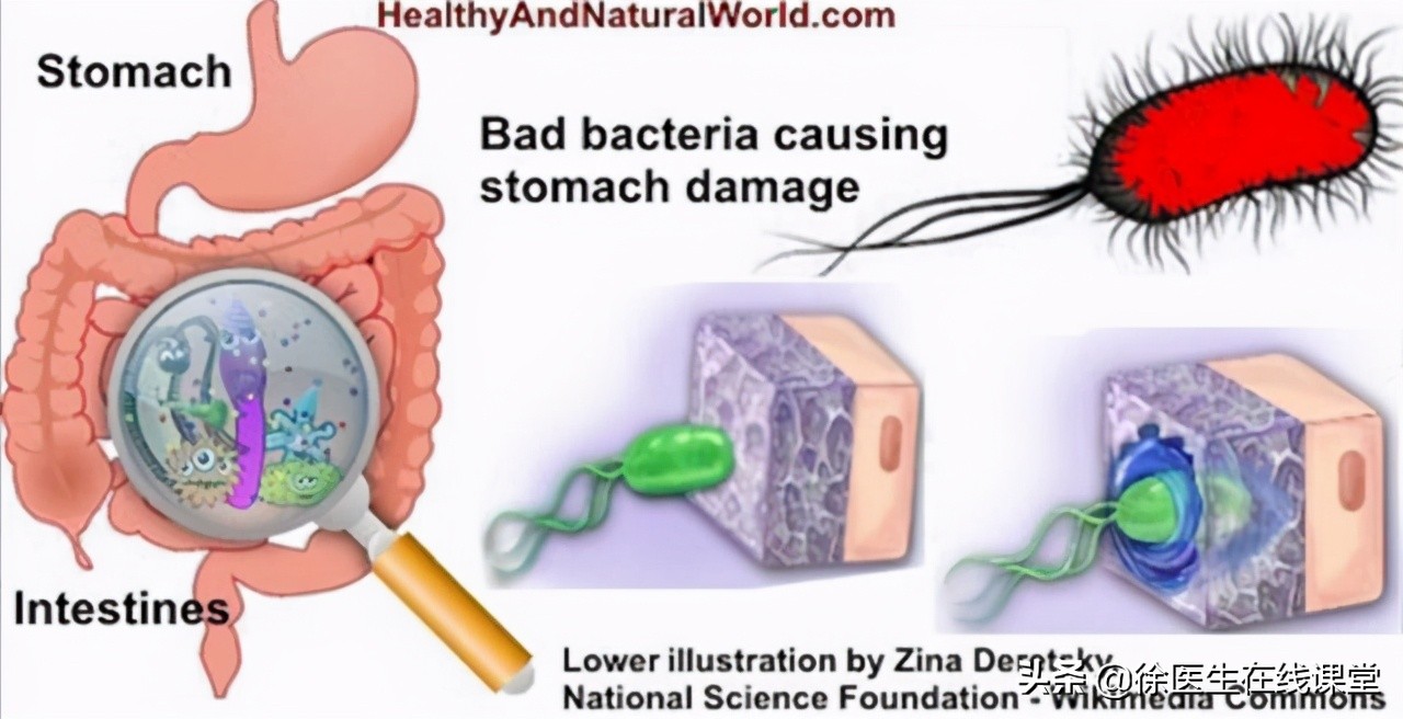 怎么根治幽门螺杆菌引起的胃病,幽门螺杆菌胃病可以治好吗