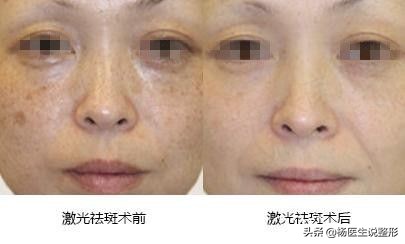 遗传性雀斑几岁可以激光祛斑,激光祛斑能不能根治雀斑