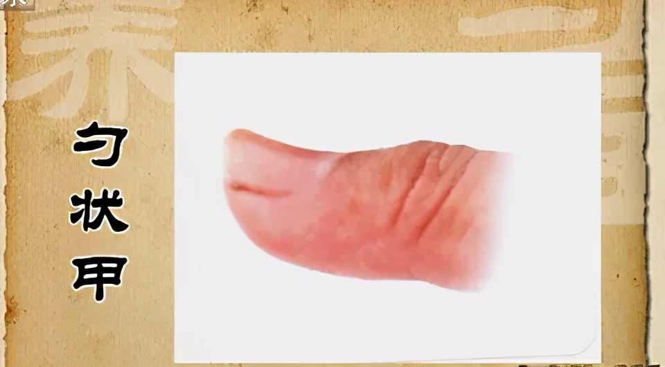 身体好不好,看手就知道!这几处变化可能藏大病