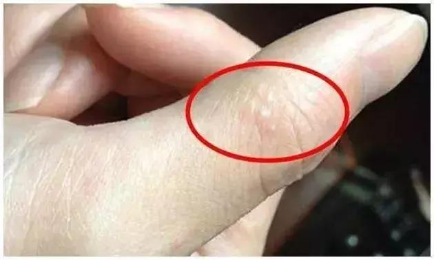 天热手上起水泡怎么回事,天气一热手上就长小水泡怎么回事