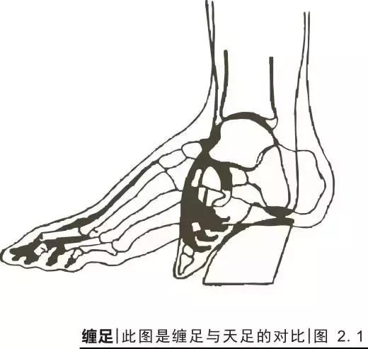 满清缠足,清朝陋习缠足