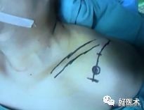 治疗肩锁关节脱位，有最好的方法吗？