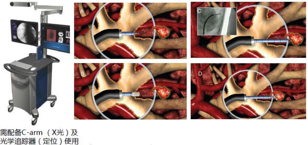 小细胞肺癌的气管镜介入治疗,导航支气管镜在肺癌诊断中的应用