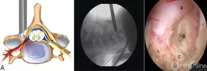 经皮腰椎间盘切除术有何优缺点,什么是经皮内镜腰椎手术