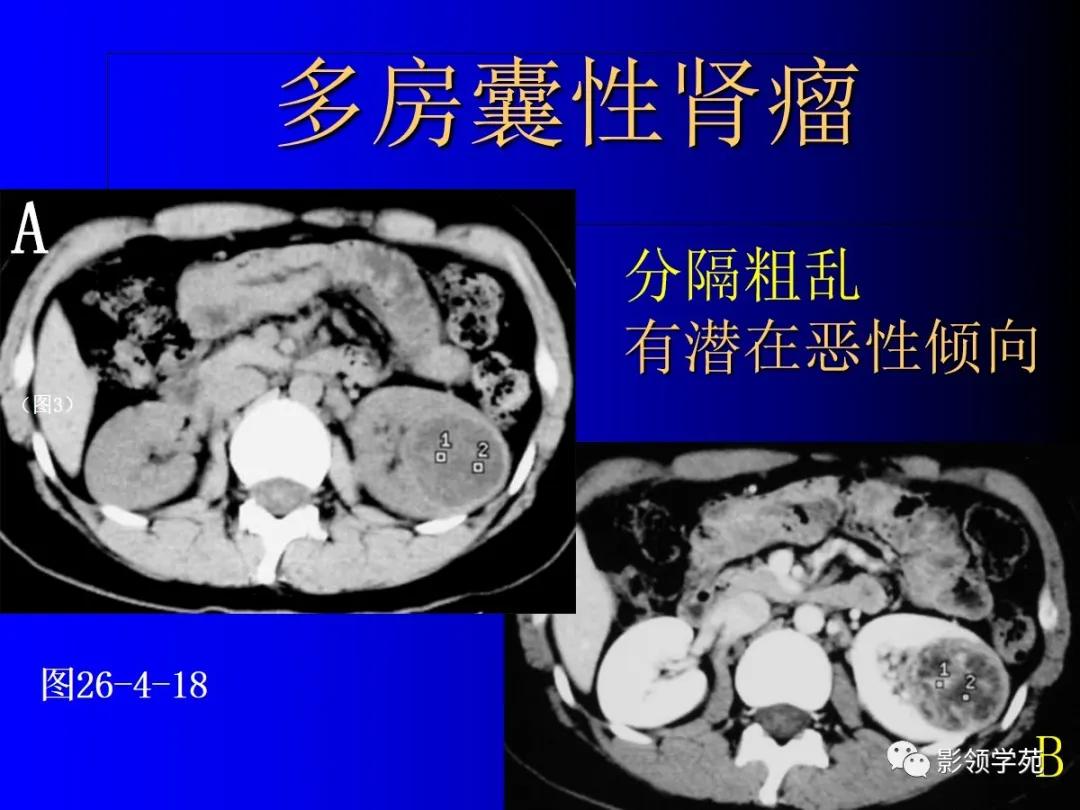 肾脏囊性肿块的影像学特点,肾脏典型病理图片及解析