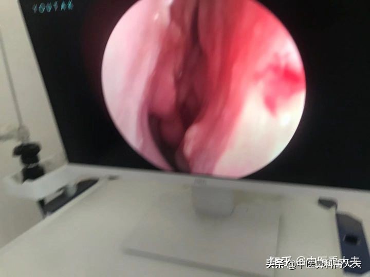 打喷嚏流鼻涕鼻炎,打喷嚏流鼻涕过敏性鼻炎怎么治