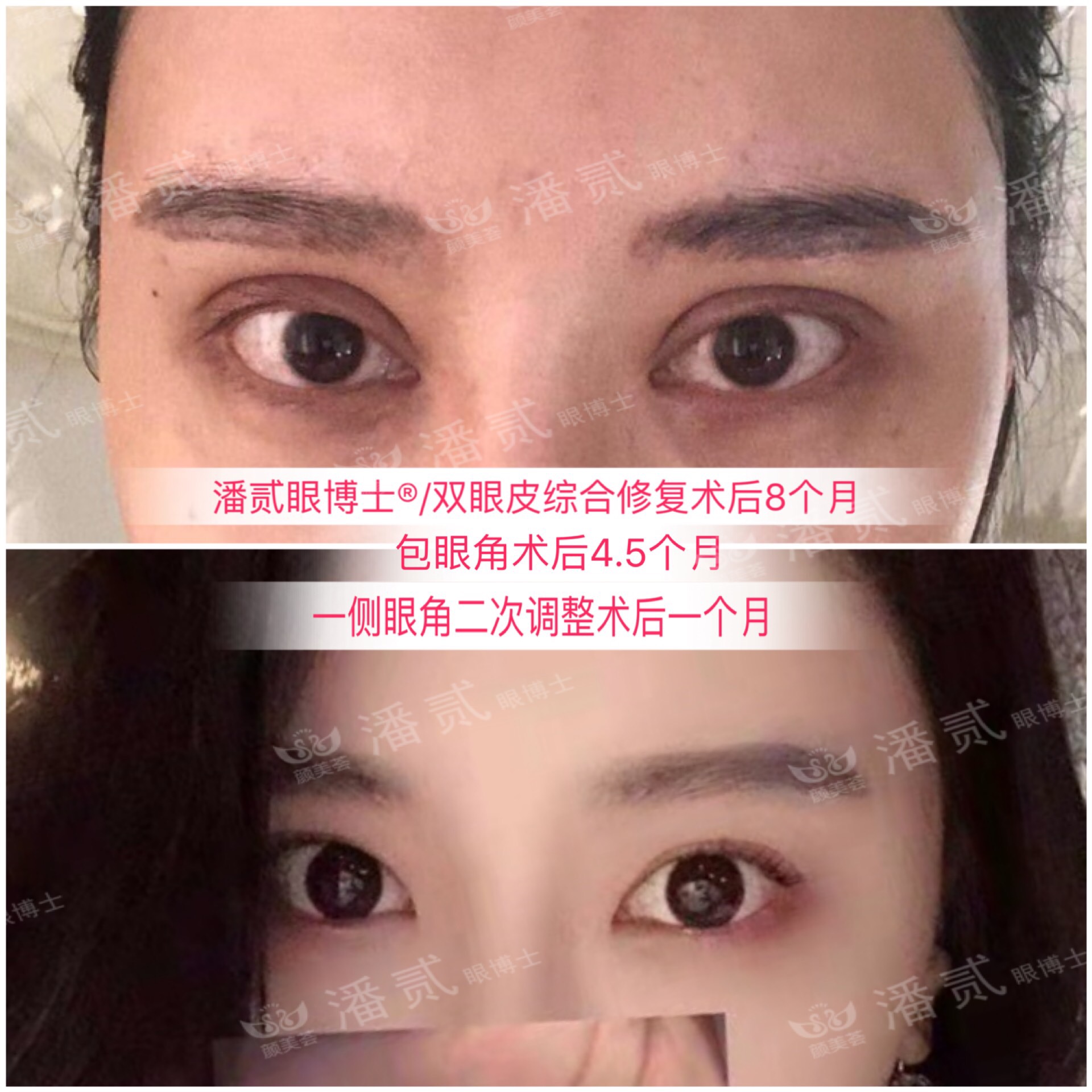 开内眼角会留疤的照片,开内眼角的疤痕变白色了怎么办