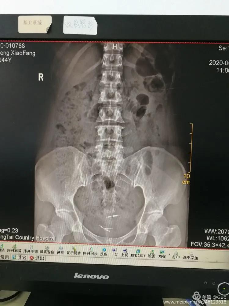 摘除节育环手术,节育环的摘除手术