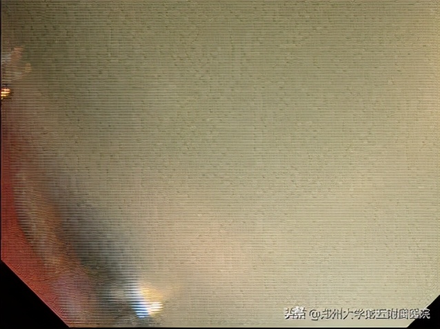 超声内镜下胰腺囊肿穿刺引流术,超声内镜下胰腺囊肿手术